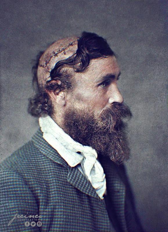 Survivor Robert McGee, scalped by Sioux Chief Little Turtle in 1864, thrives in 1890.