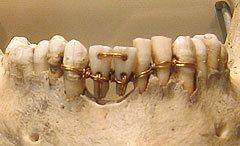 2500 B.C. Egyptians used gold wire ligatures for dental stability.