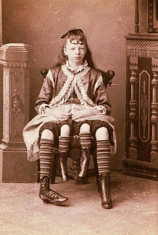 1880 photo captures dipygus Myrtle Corbin: born with two pelvises and four legs