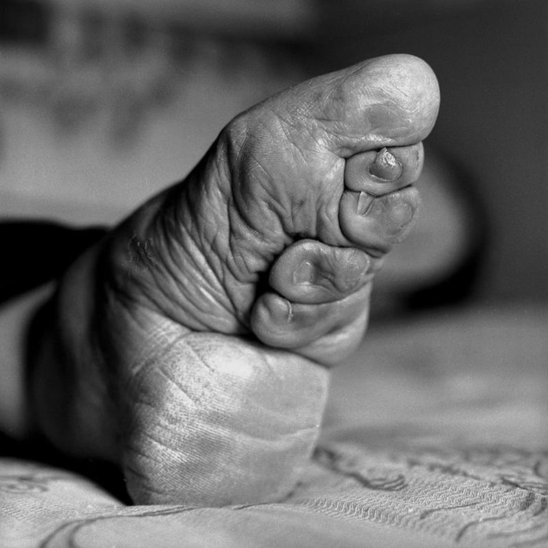 Foot binding begins before the arch fully develops.
