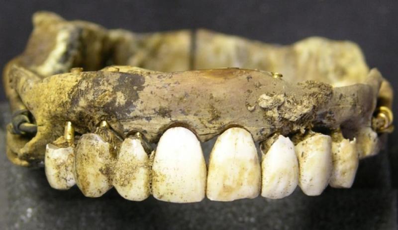 Dentures Made from Fallen Soldiers' Teeth Used in the Past